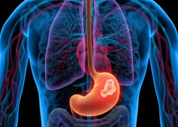 Gastric Cancer: A Major Global Health Concern with High Prevalence in East Asia and Bangladesh